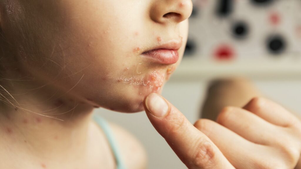 Chickenpox Vaccine in Bourne End