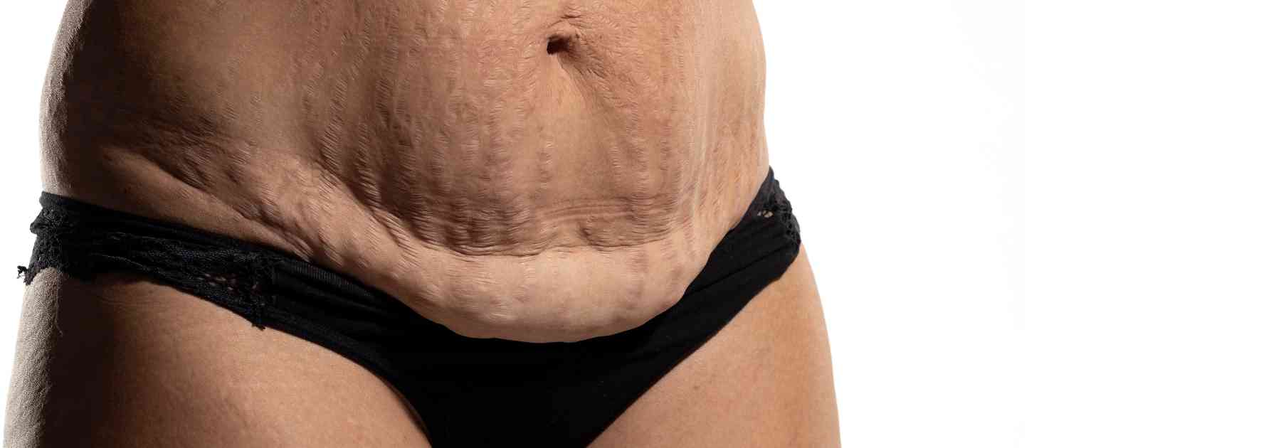 how to avoid loose skin when losing weight uk